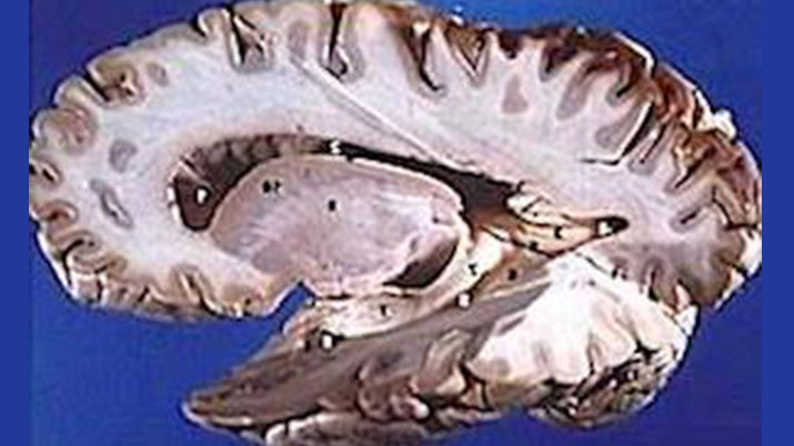 heroin brain